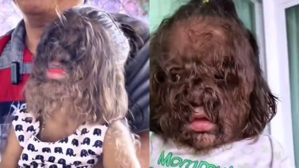 “Síndrome do Lobisomem”: Menina de dois anos enfrenta doença rara e preconceito